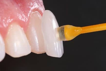 Lente Dental em Ponte Nova