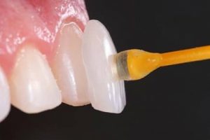 Lente Dental em Ponte Nova